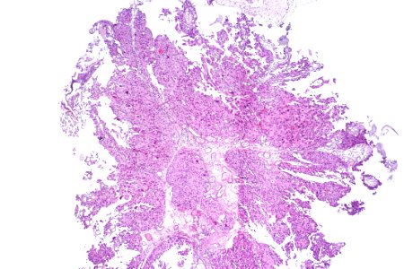 Papillary urothelial carcinoma (high-grade), low mag