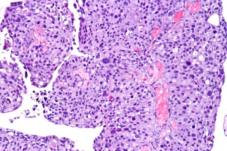 Papillary urothelial carcinoma (high-grade), high mag.1