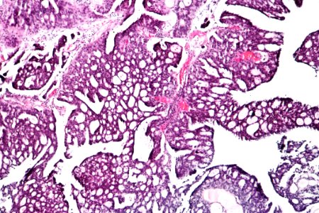 Papillary urothelial carcinoma with cribriform morphology, intermed. mag