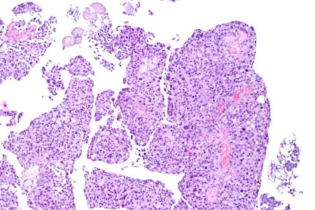 Papillary urothelial carcinoma (high-grade), intermed. mag.1