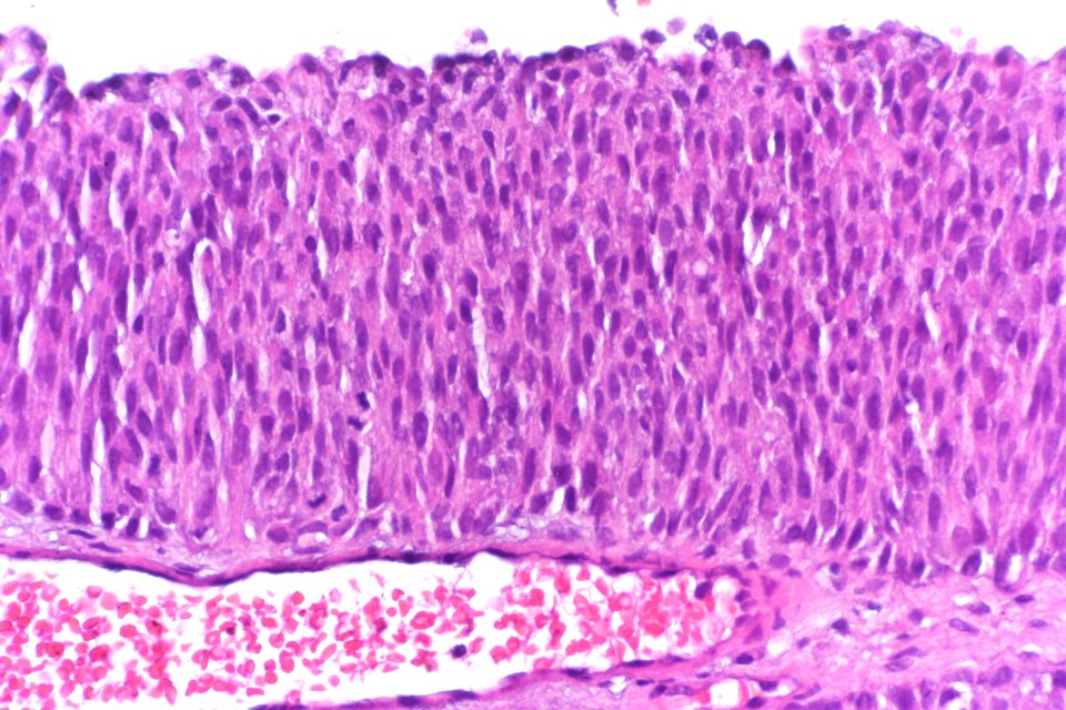 Papillary urothelial carcinoma (low-grade), very high mag