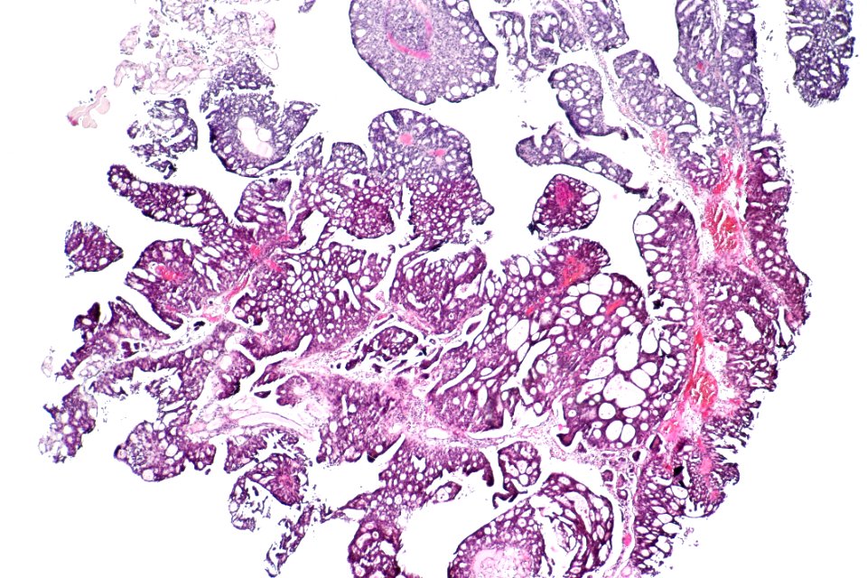 Papillary urothelial carcinoma with cribriform morphology, low mag