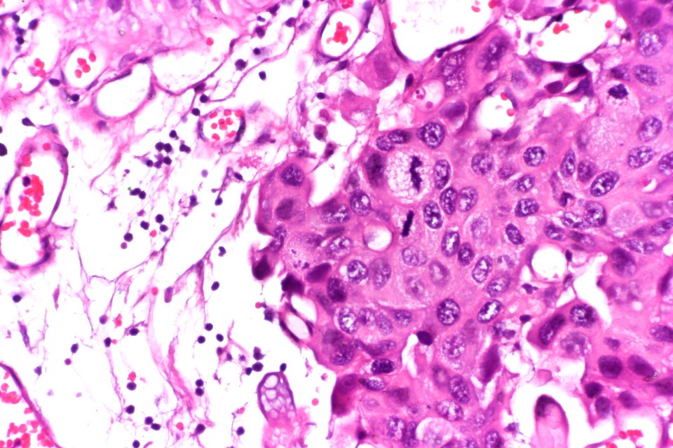 Papillary urothelial carcinoma with early invasion, very high mag