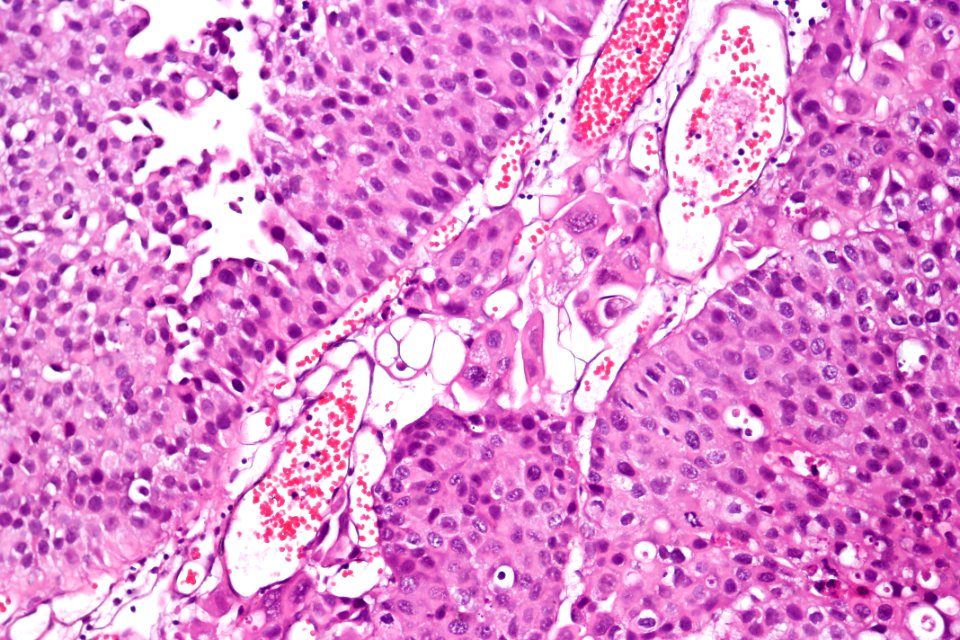 Papillary urothelial carcinoma with early invasion, high mag