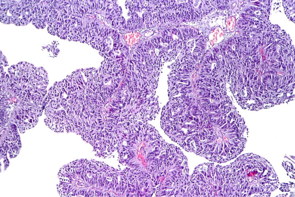 Papillary urothelial carcinoma with glandular differentiation, intermed. mag