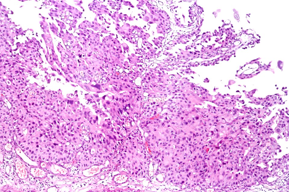 Papillary urothelial carcinoma (high-grade), intermed. mag.3