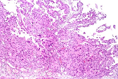 Papillary urothelial carcinoma (high-grade), intermed. mag.3