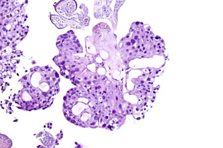 Papillary urothelial carcinoma (high-grade), high mag.2