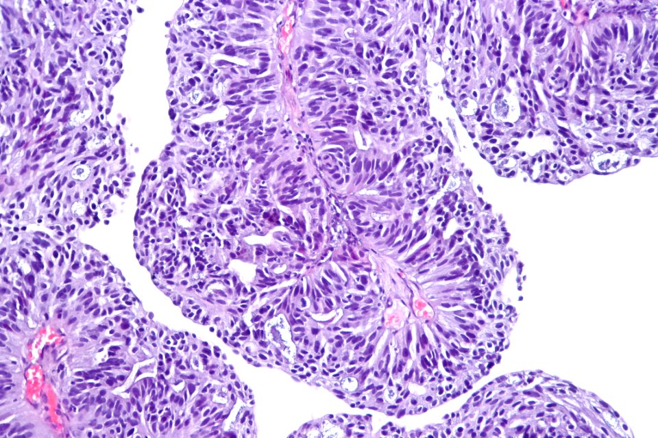 Papillary urothelial carcinoma with glandular differentiation, high mag