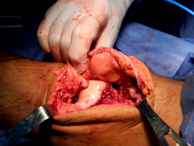 Patella surgery