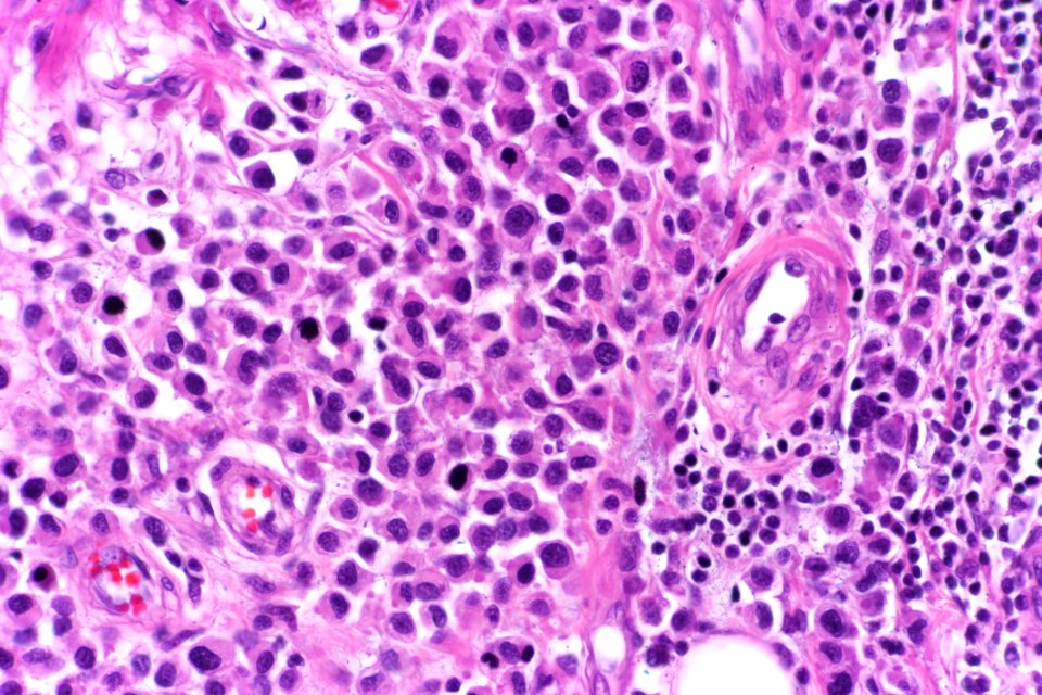 Plasmacytoid urothelial carcinoma, very high mag.1