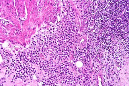 Plasmacytoid urothelial carcinoma, high mag