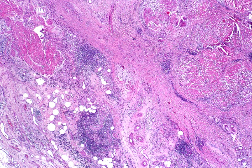 Plasmacytoid urothelial carcinoma, low mag.2
