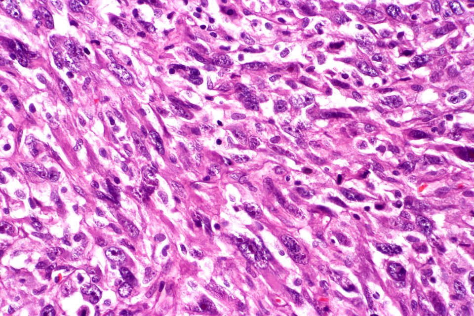 Sarcomatoid carcinoma of the urinary bladder, very high mag.1