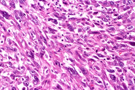 Sarcomatoid carcinoma of the urinary bladder, very high mag.1