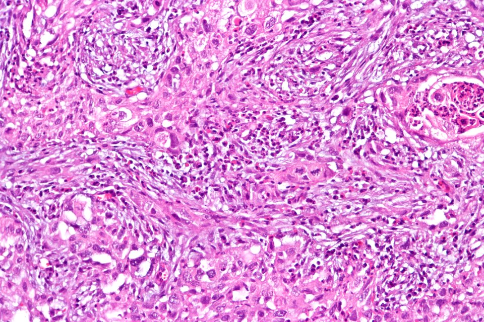 Sarcomatoid carcinoma of the urinary bladder, high mag