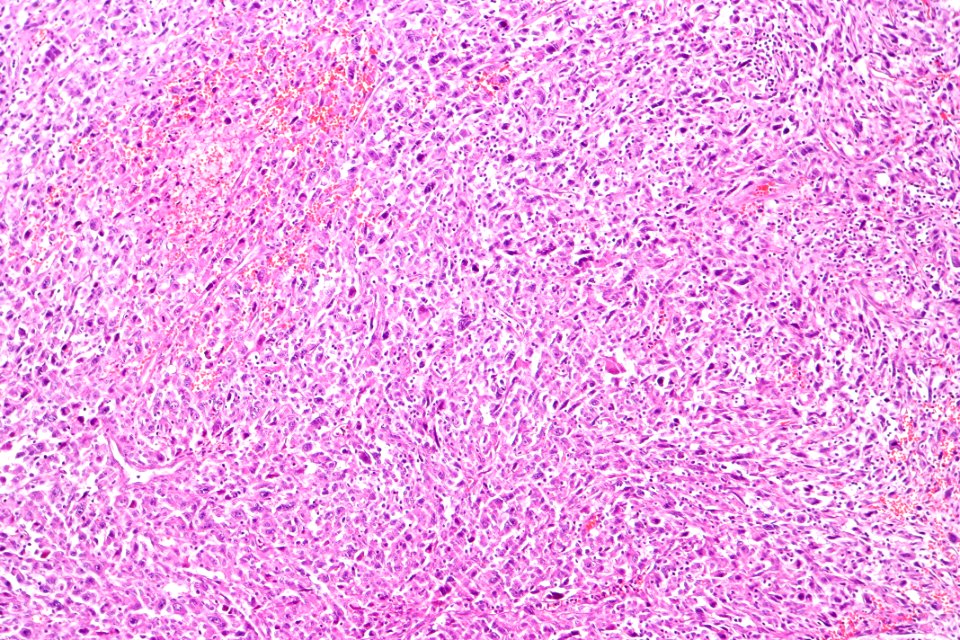 Sarcomatoid carcinoma of the urinary bladder, intermed. mag.2