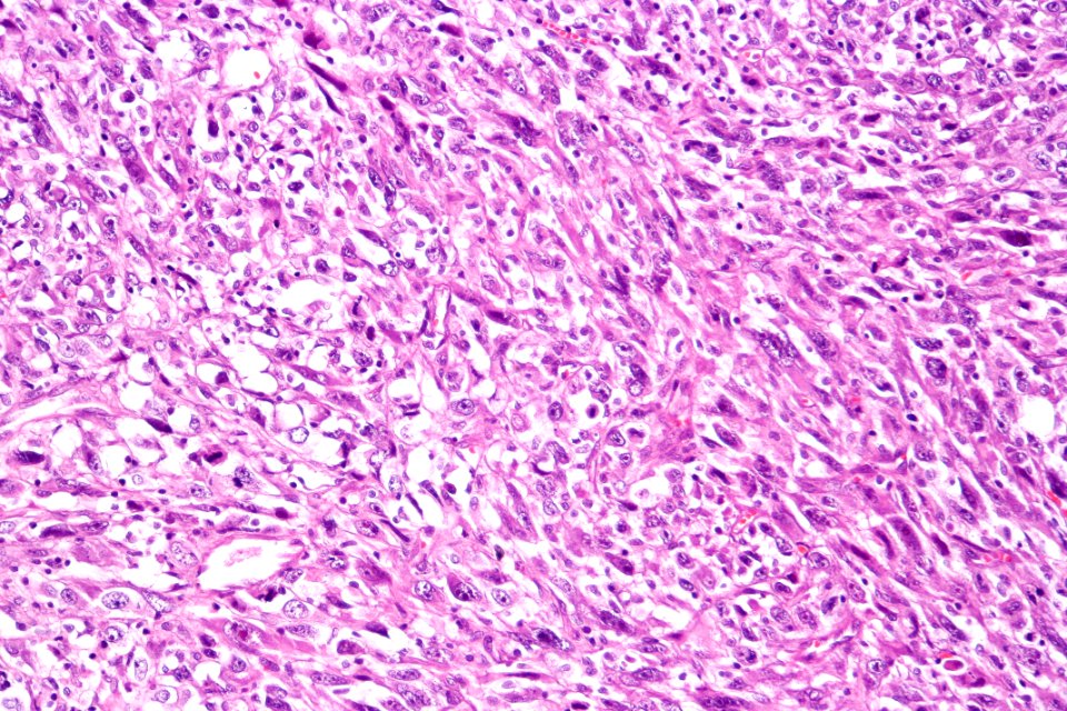 Sarcomatoid carcinoma of the urinary bladder, high mag.1