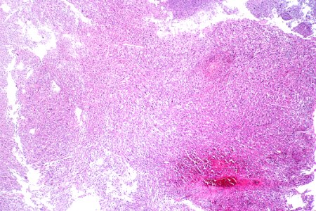Sarcomatoid carcinoma of the urinary bladder, low mag.1