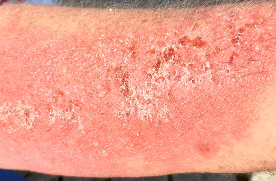 Skin after contact with Heracleum sosnowskyi