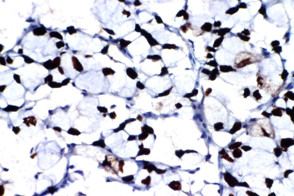 Signet ring cell carcinoma of the urinary bladder - CDX2, very high mag