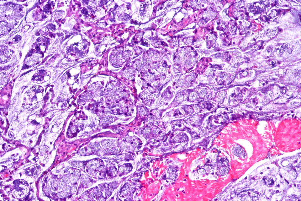 Signet ring cell carcinoma of the urinary bladder, high mag