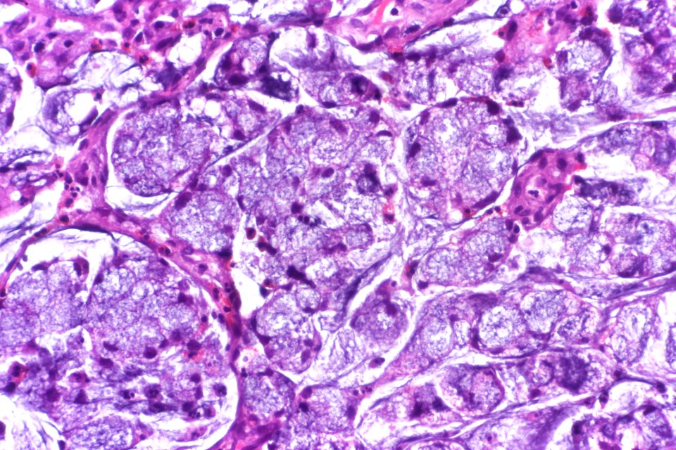 Signet ring cell carcinoma of the urinary bladder, very high mag