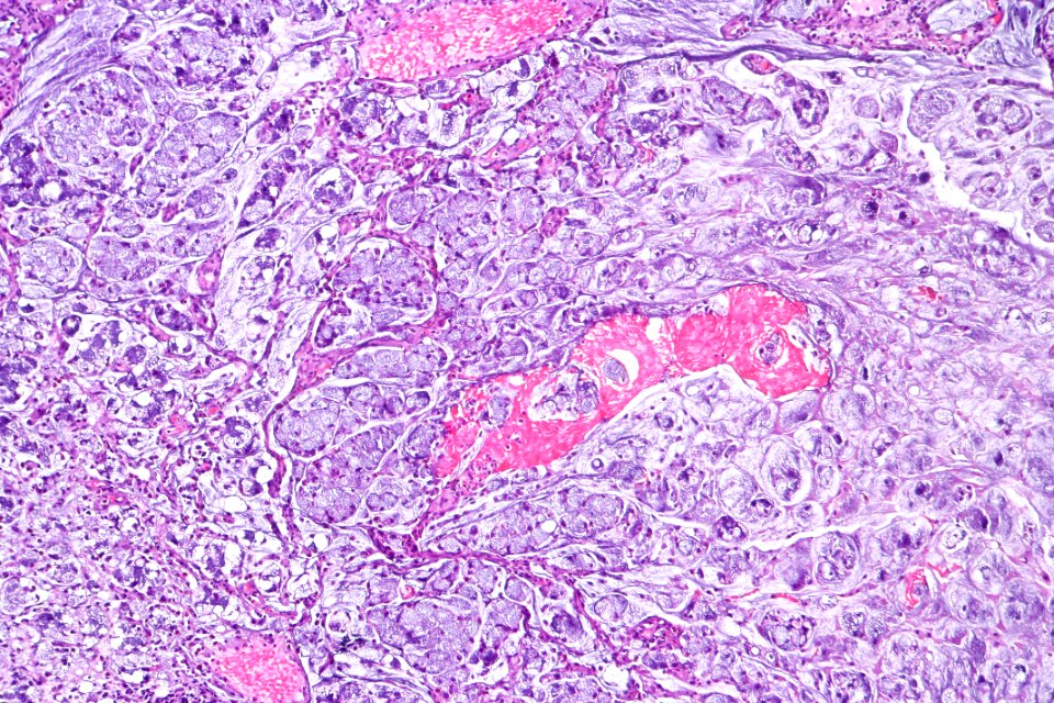 Signet ring cell carcinoma of the urinary bladder, intermed. mag.2
