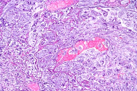 Signet ring cell carcinoma of the urinary bladder, intermed. mag.2