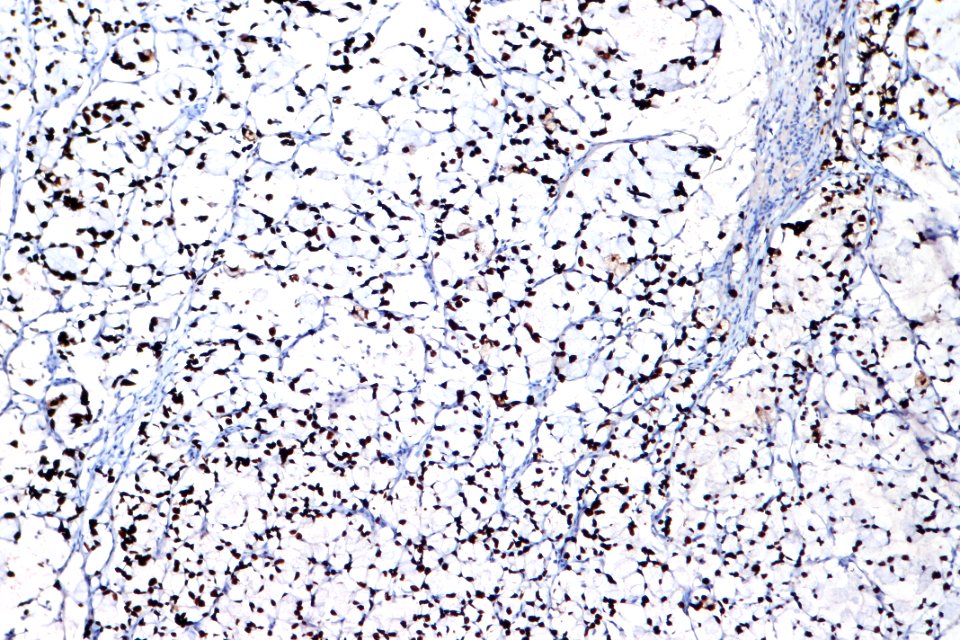 Signet ring cell carcinoma of the urinary bladder - CDX2, intermed. mag
