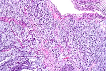 Signet ring cell carcinoma of the urinary bladder, intermed. mag.1