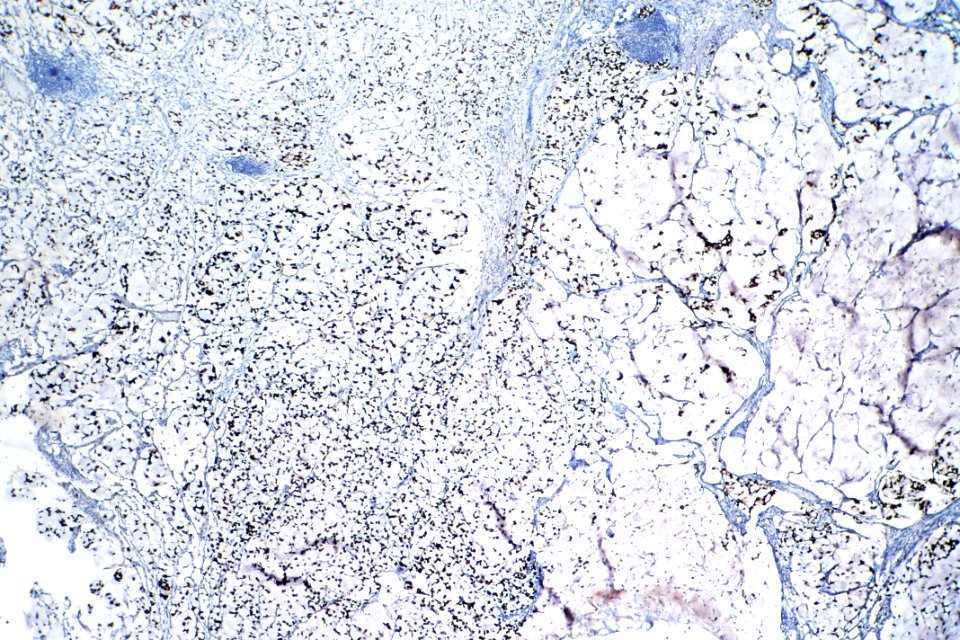 Signet ring cell carcinoma of the urinary bladder - CDX2, low mag