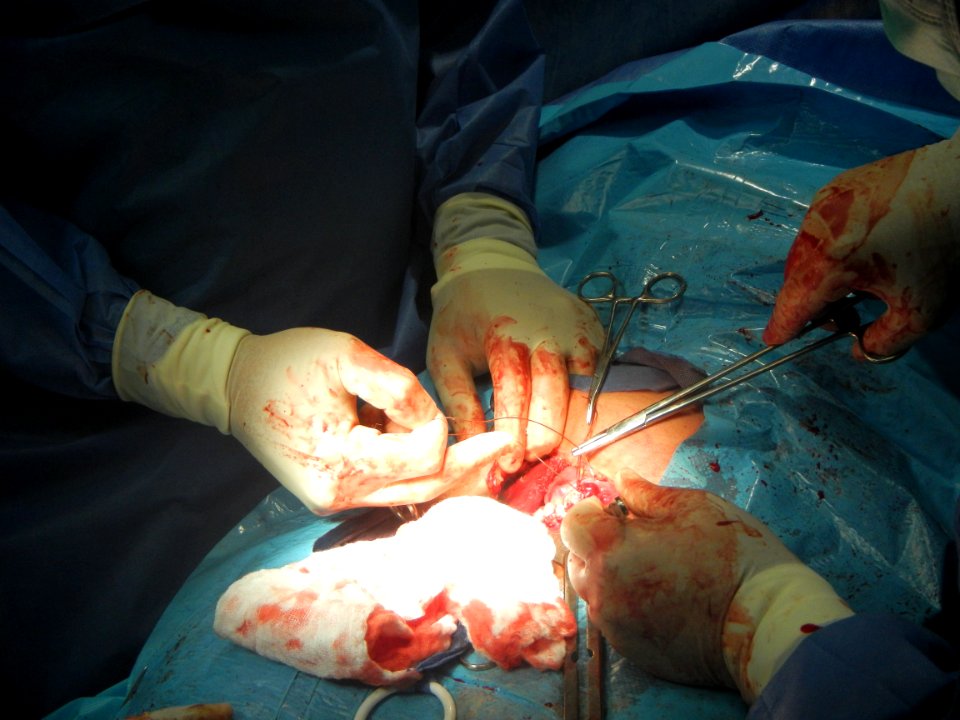 Suture of cesarean