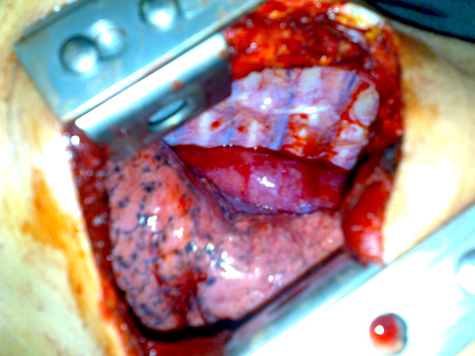Surgical removal of the esophagus 09
