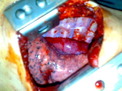 Surgical removal of the esophagus 09