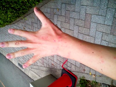The left arm on the 3rd day after starting erytheme exudativum multiforme