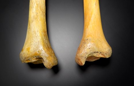 Tibia - malleolus medialis (dex, sin)