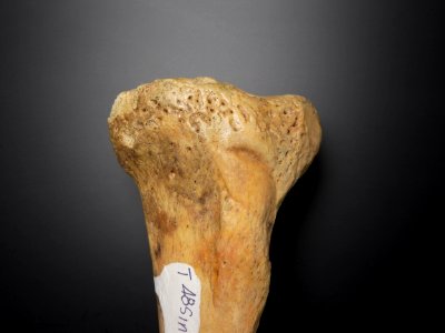 Tibia - condylus lateralis et medialis