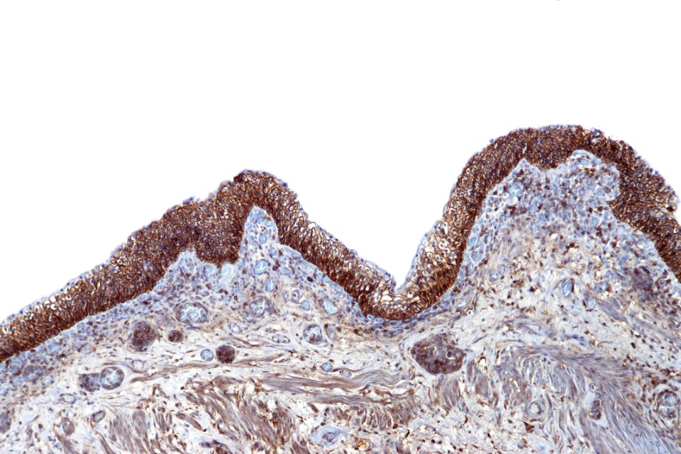 Reactive urothelium - CD44, intermed. mag