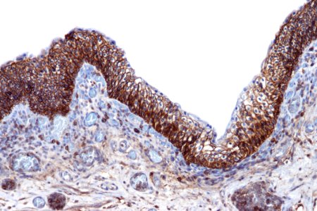 Reactive urothelium - CD44, high mag