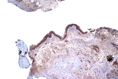 Reactive urothelium - CD44, low mag