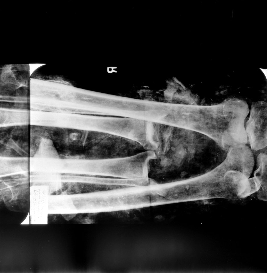 Röntgenfoto van de benen en knieën van de Zwolse mummie, Bestanddeelnr 907-1829