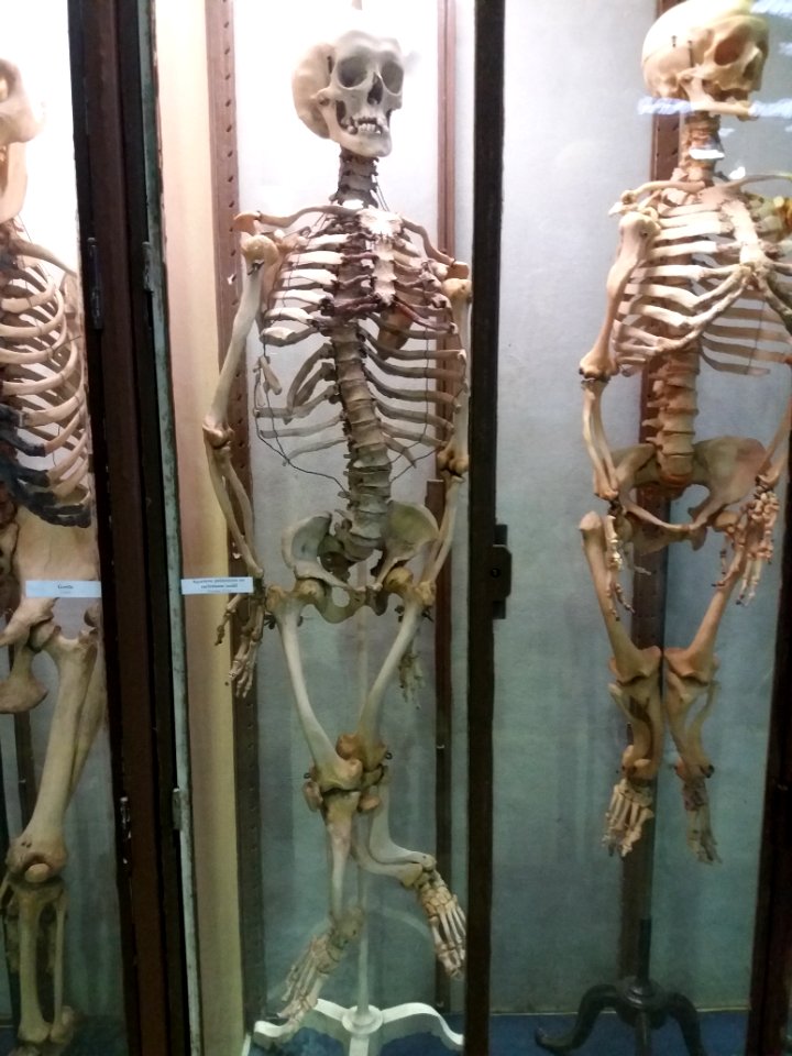 Rillieux-la-Pape - Musée Testut-Latarjet, squelette d'un homme de 53 ans atteint de rachitisme tardif