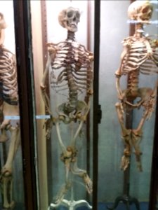 Rillieux-la-Pape - Musée Testut-Latarjet, squelette d'un homme de 53 ans atteint de rachitisme tardif