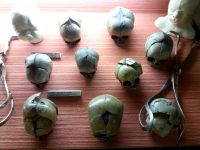 Rillieux-la-Pape - Musée Testut-Latarjet, crânes de nourrissons accidentés par des forceps