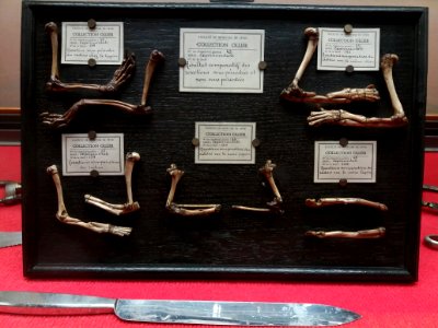Rillieux-la-Pape - Musée Testut-Latarjet, collection Léopold Ollier, résultat comparatif des resections sous-périostées et non sous-périostées