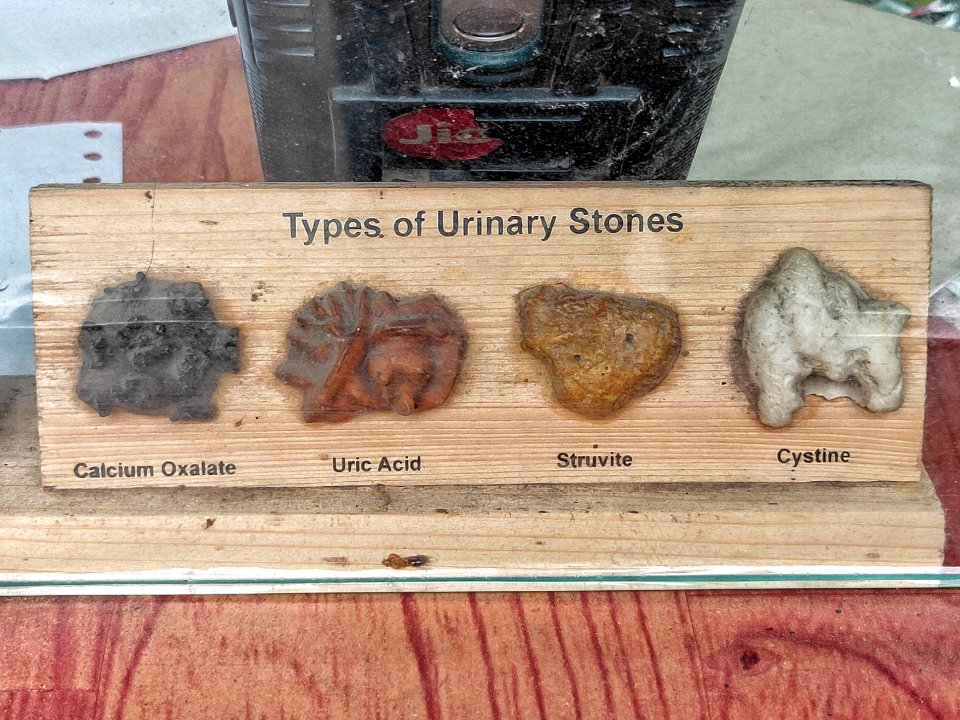 Types of Urinary Stones