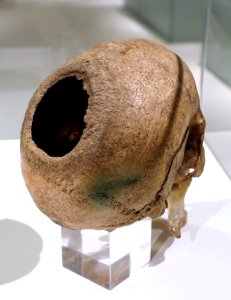 Trepanned skull, found at Börnecke Schützenholz, c. 3300 BC, human skull - Braunschweigisches Landesmuseum - DSC04592
