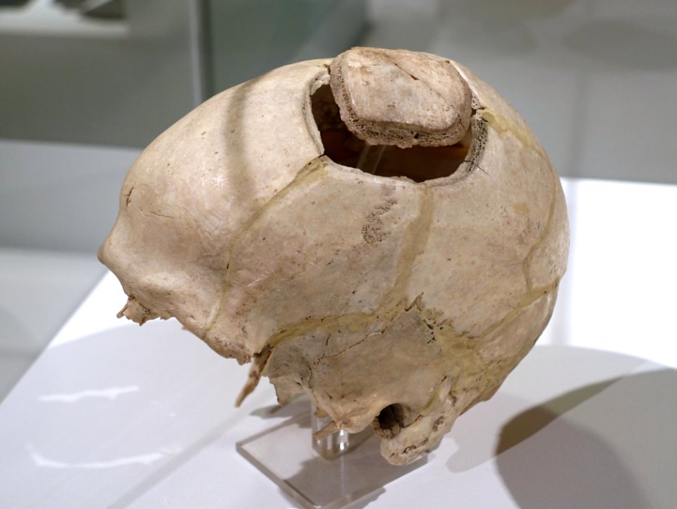 Trepanned skull, found at Börnecke Schützenholz, c. 3300 BC, human skull - Braunschweigisches Landesmuseum - DSC04591