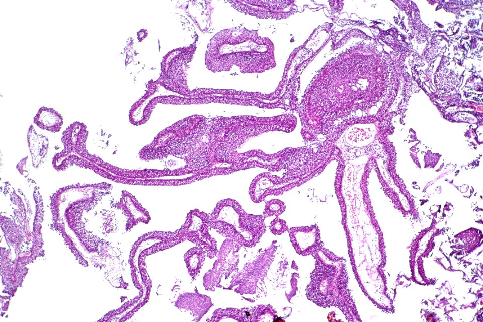 Urothelial papilloma, low mag